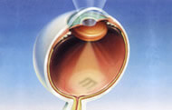 Advanced Cataract Surgery Impaired Vision