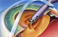 Advanced Cataract Surgery Removal Of Natural Lens
