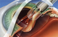 Advanced Cataract Surgery Lens Placement
