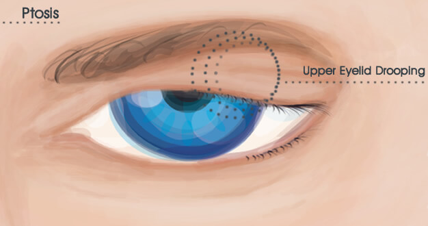 Ptosis Treatment